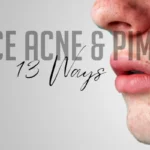 13-Ways-to-reduce-Acne-&-Pimple