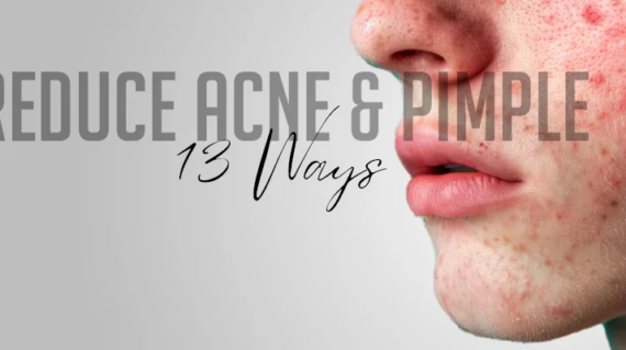 13-Ways-to-reduce-Acne-&-Pimple