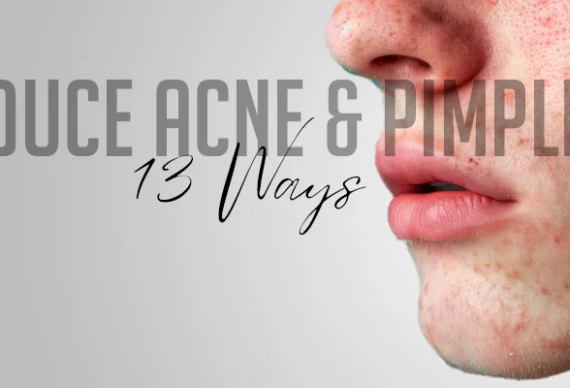 13-Ways-to-reduce-Acne-&-Pimple