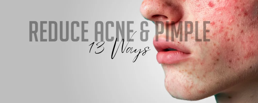 13-Ways-to-reduce-Acne-&-Pimple